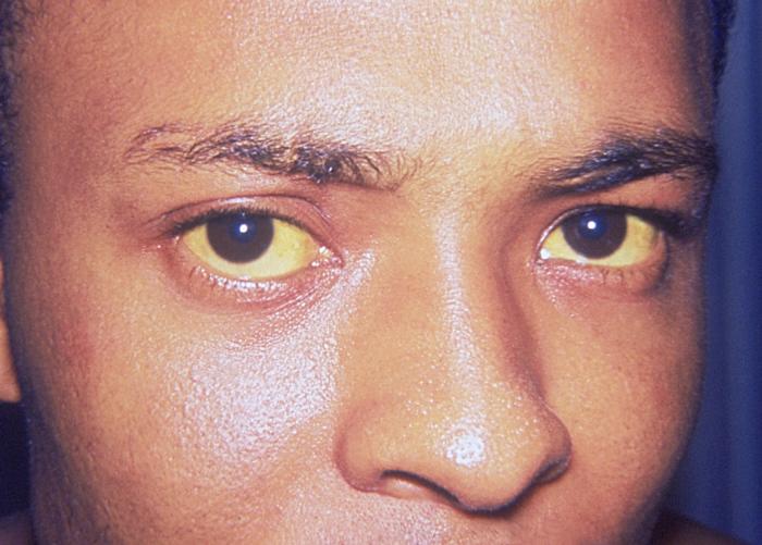 Yellowing of the skin and eyes (jaundice)