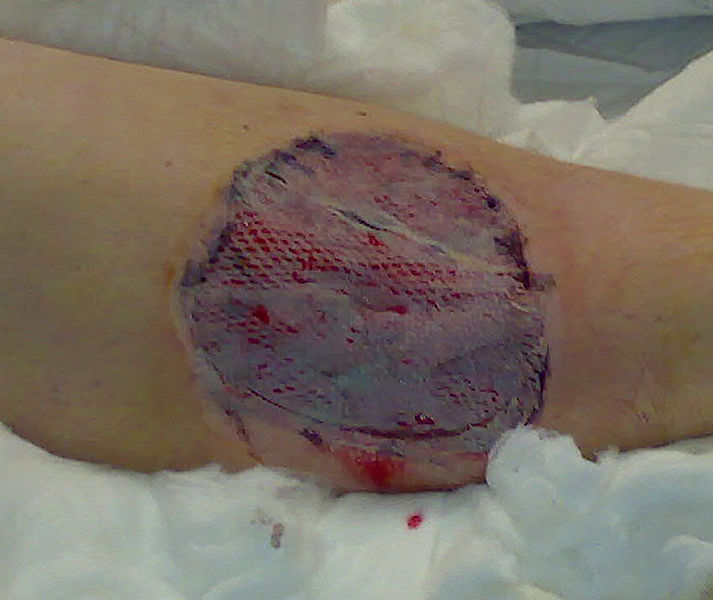 Skin graft on lower leg trauma injury, some 5 days after surgery. Take and healing aided by use of Vacuum Assisted Closure.
