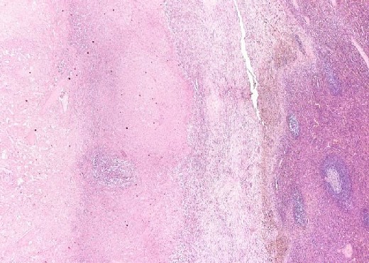 Splenic infarction (left) with homogenous pinkish appearance.jpg