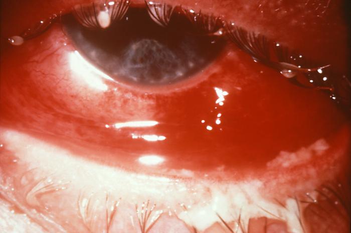 This case of gonorrheal conjunctivitis resulted in partial blindness due to the spread of N. gonorrhoeae bacteria.Gonococci cause both localized infections, usually in the genital tract, and disseminated infections with seeding of various organs. Diagnosis of localized infections depends on Gram-staining, and culture of the discharge.