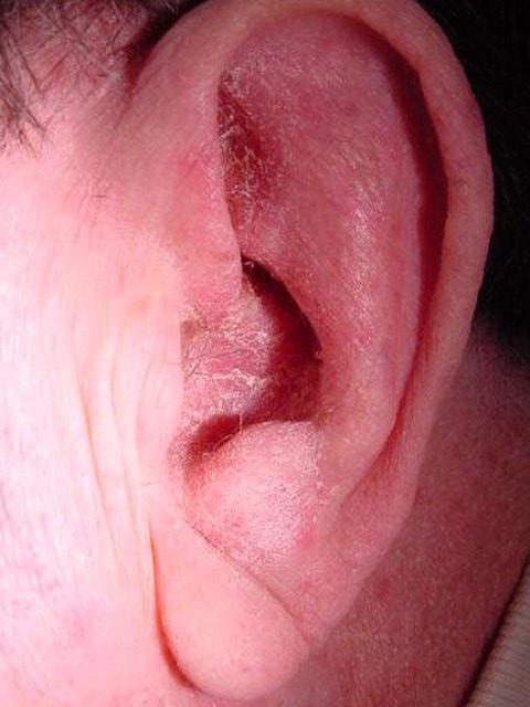 Otitis externa and seborrheic dermatitis.[5]