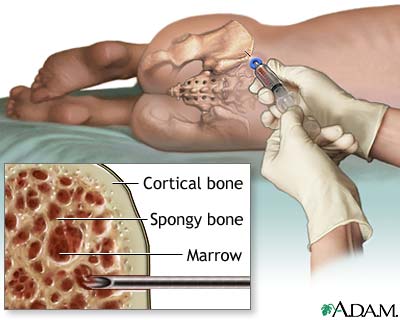 Bone marrow aspiration 1.jpg