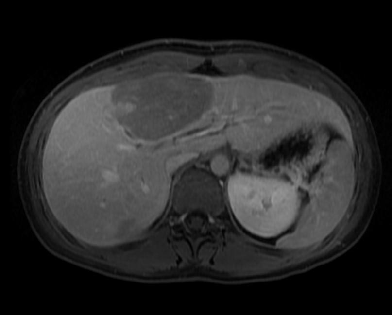 T1 fat sat delayed: A patient with multiple adenoma