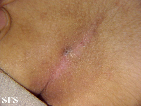 Pilonidal sinus. With permission from Dermatology Atlas.[1]