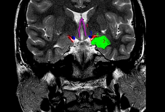 File:Anatomy of amygdala.jpg