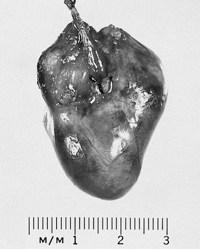 Heart-Great Vessels: Bronchogenic cyst; This example was removed from the epicardial surface of a 13-year-old.