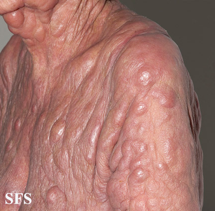 File:Mycosis fungoides 15.jpg