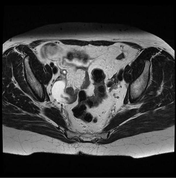 File:Primary-fallopian-tube-carcinoma-001.jpg