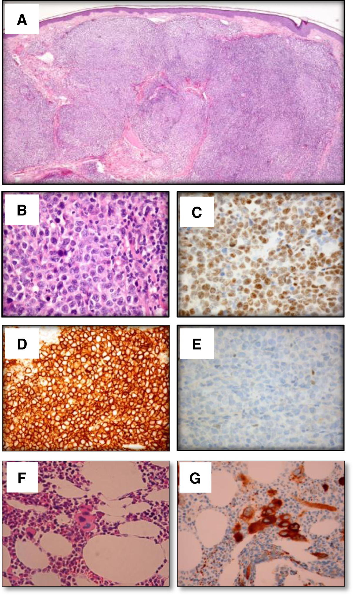 File:Primary cutaneous follicle centre lymphoma image 2.jpg