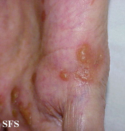 Reiter's syndrome. Adapted from Dermatology Atlas.[2]
