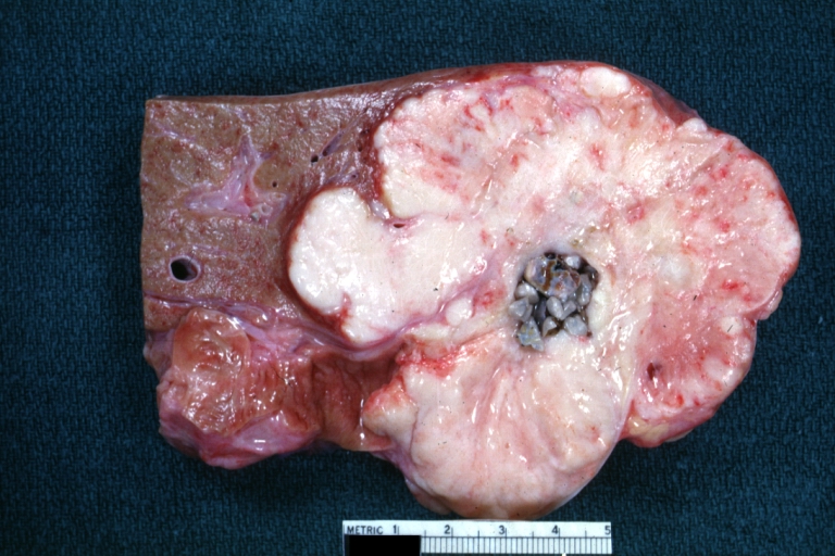 Gallbladder carcinoma: Gross, natural color, close-up view of liver and gallbladder slice with typical neoplasm invading liver and surround a cavity with mixed type gallstones