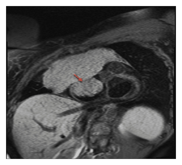 Cardiac MRI short axis T1 at the level of mitral valve reveals a large mediastinal mass infiltrating and obliterating the SVC causing SVC obstruction. The tumor extends into the right atrium (red arrow) and invades the tricuspid valve.[5]