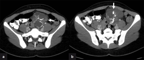 File:Struma ovarii Axial CT images.jpg