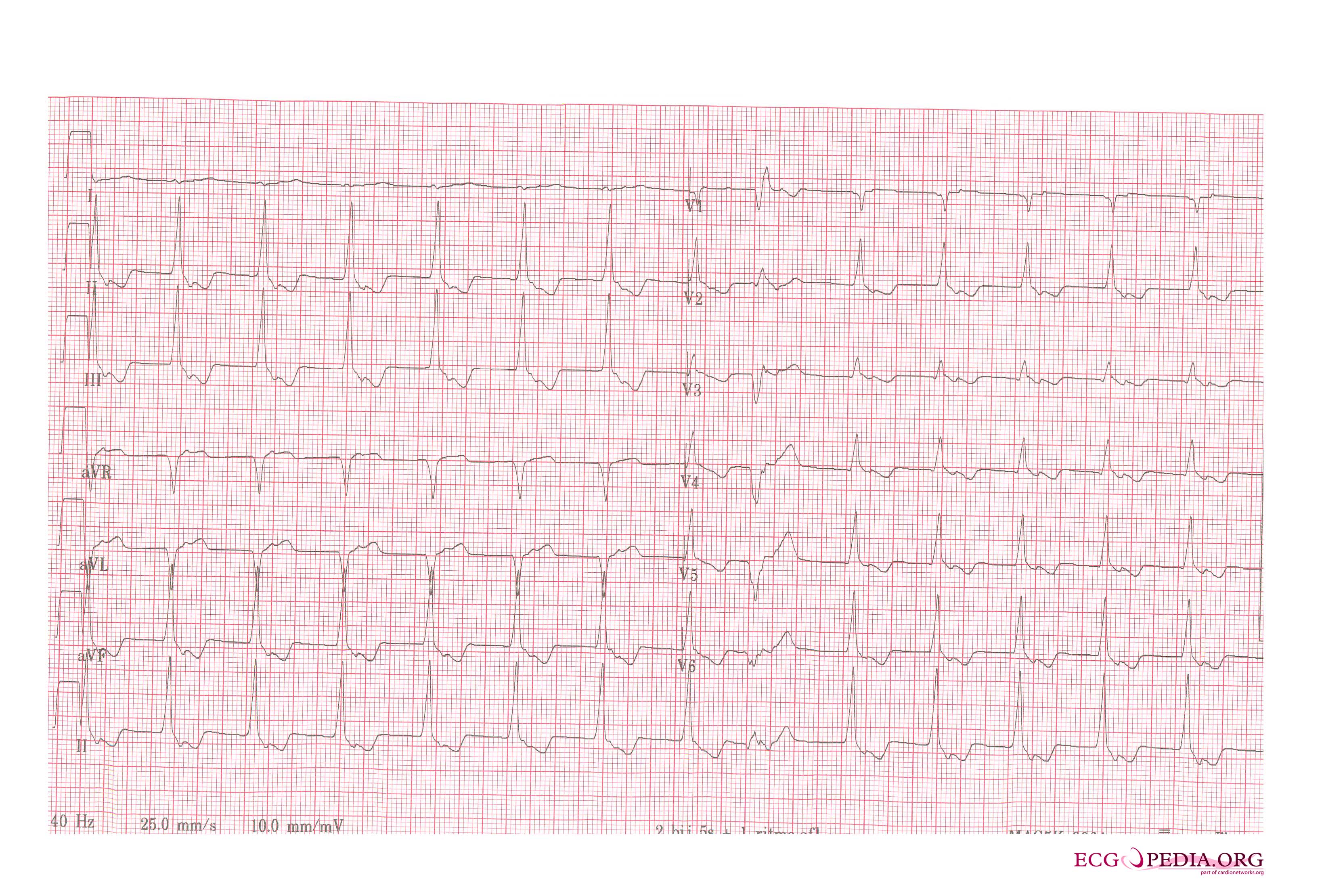 AIVR. Inverted P waves are sign of retrograde atrial activation.