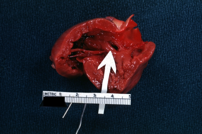 Ventricular Septal Defect: Gross, infant heart, pulmonary outlet, muscular septal defect