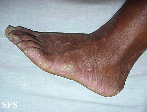 Darier's disease. Adapted from Dermatology Atlas.[1]