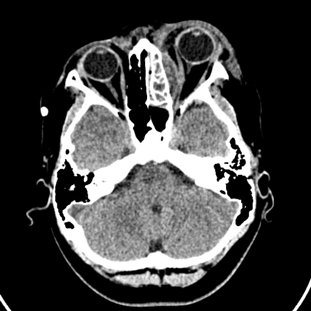 Left-sided orbital cellulitis and subperiosteal abscess on CT scan
