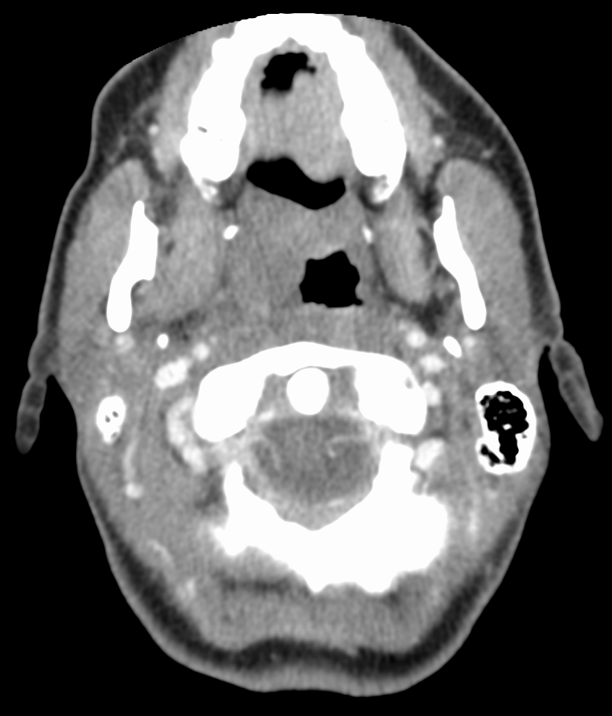 CT scan showing and oval right sided peritonsillar abscess