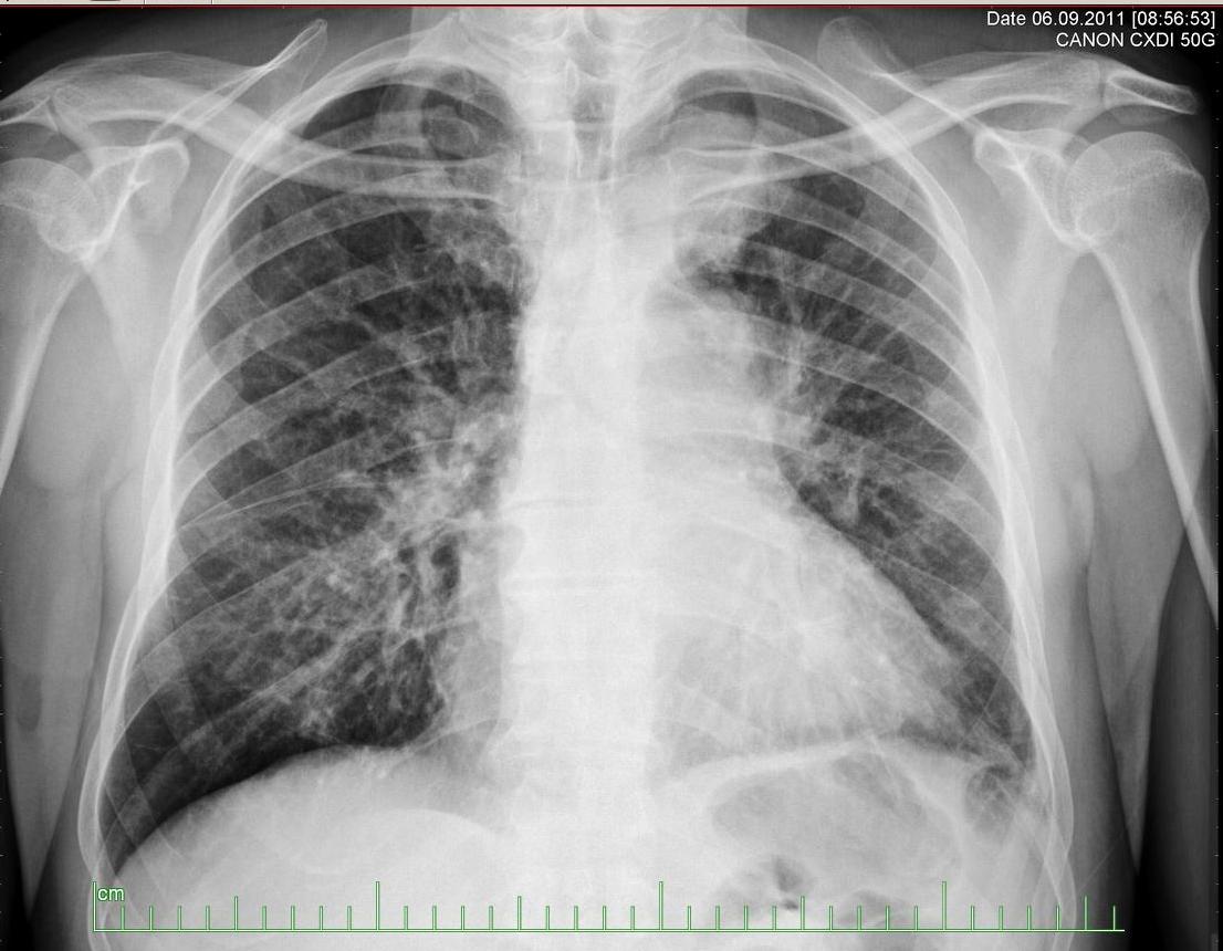 Chest x-ray: Small cell carcinoma of the lung. At the time of diagnosis.