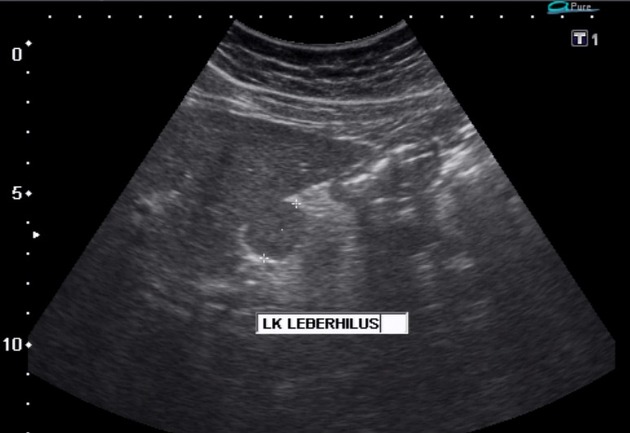 File:Splenic marginal zone lymphoma ultrasound sagital.jpeg