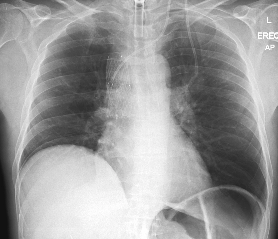 File:Superior-vena-cava-stent-and-tracheostomy-on-chest-x-ray(1).png