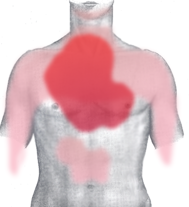 Rough diagram of pain zones in myocardial infarction (dark red = most typical area, light red = other possible areas, view of the chest).