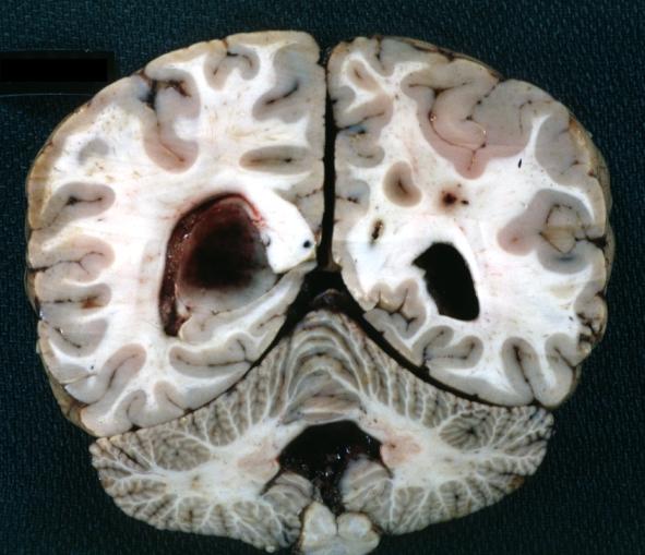 Brain: Glioma Thalamic Grade Ii-Iii: Gross fixed tissue coronal section cerebral hemispheres lesions appears to be in choroid plexus of lateral ventricle in this picture. There is blood in fourth ventricle