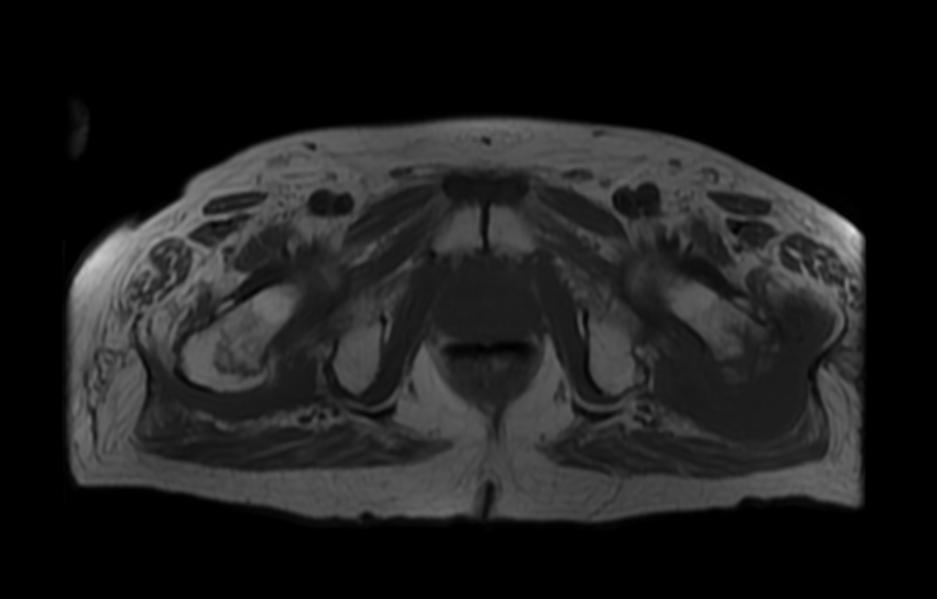 File:Greater trochanter bursitis MRI 004.jpg