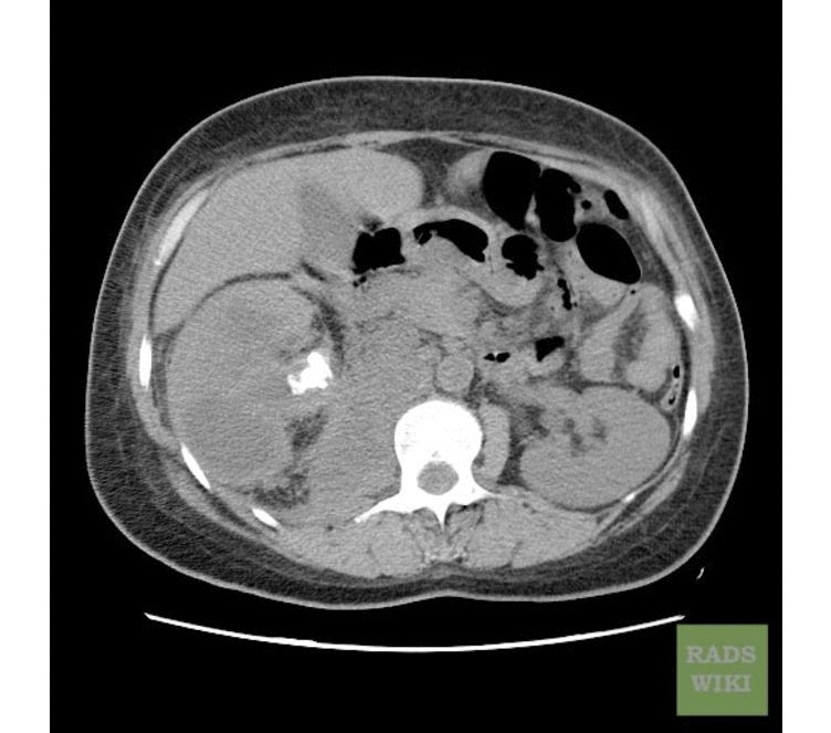File:XP Dilated renal calyces.gif