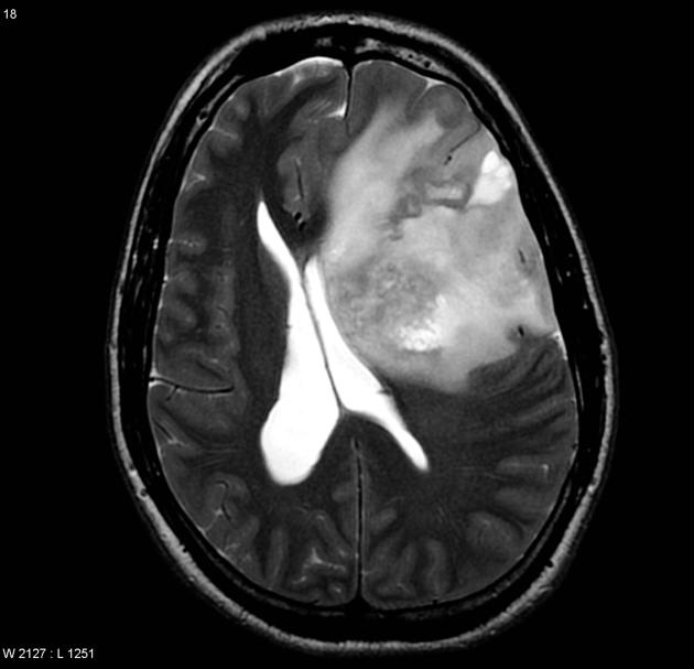 File:Anaplastic oligoastrocytoma MRI T2.jpg