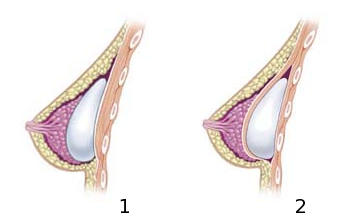 Diagrams of cross sections of breast implants, subglandular (left) and submuscular (right)