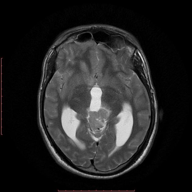 Axial T2-weighted MRI image demonstrating a lesion that is hyperintense.[20]