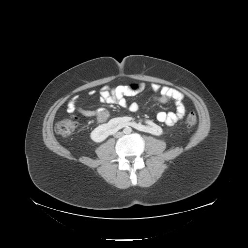 CT image demonstrates a horseshoe kidney