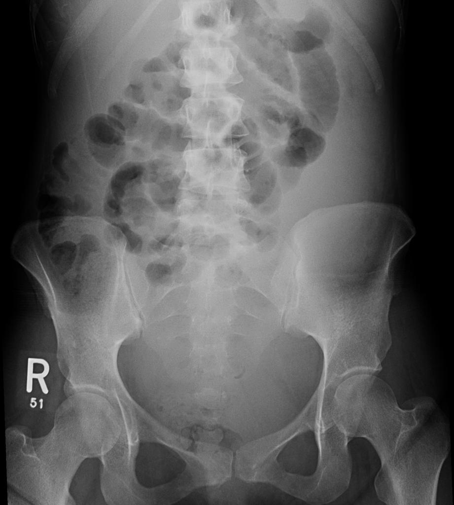 X ray showing prominent small bowel loops filled with gas, no air-fluid level, no radiographic signs of intestinal obstruction[10]