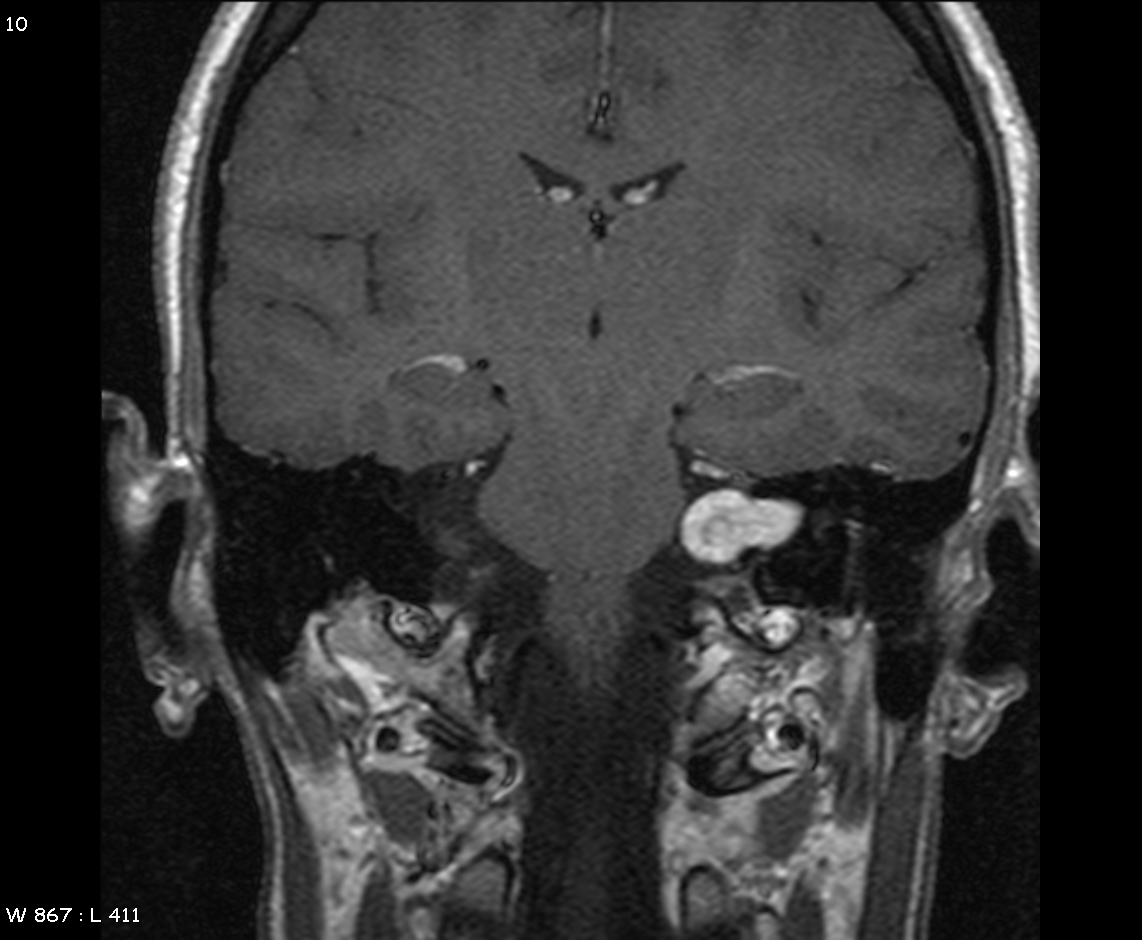 MRI demonstrating left acoustic neuroma in the CP angle==Overview==