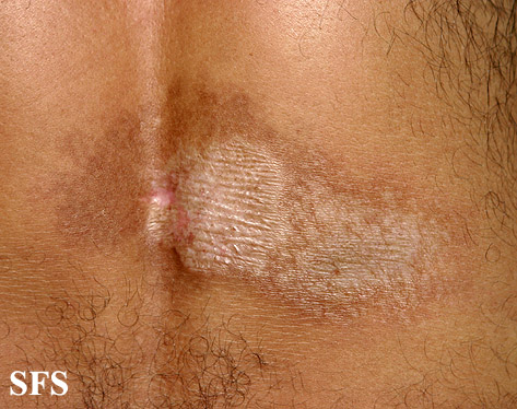 Lichen sclerosus et atrophicus. Adapted from Dermatology Atlas.[6]