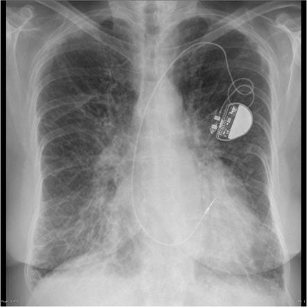 Pulmonary edema with Kerley B lines. (Image courtesy of Radiopaedia.org)
