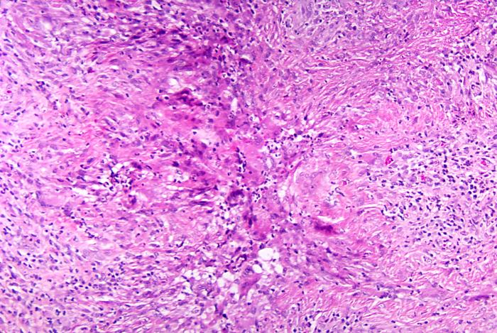 Histopathologic changes associated with phaeohyphomycosis due to P. parasitica using H&E stain. From Public Health Image Library (PHIL). [2]