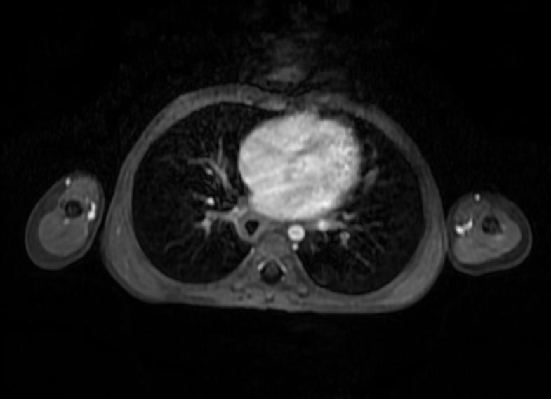 File:Esophageal leiomyomatosis MRI 003.jpg