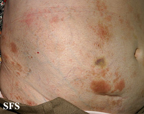 Large plaque parapsoriasis. Adapted from Dermatology Atlas.[4]
