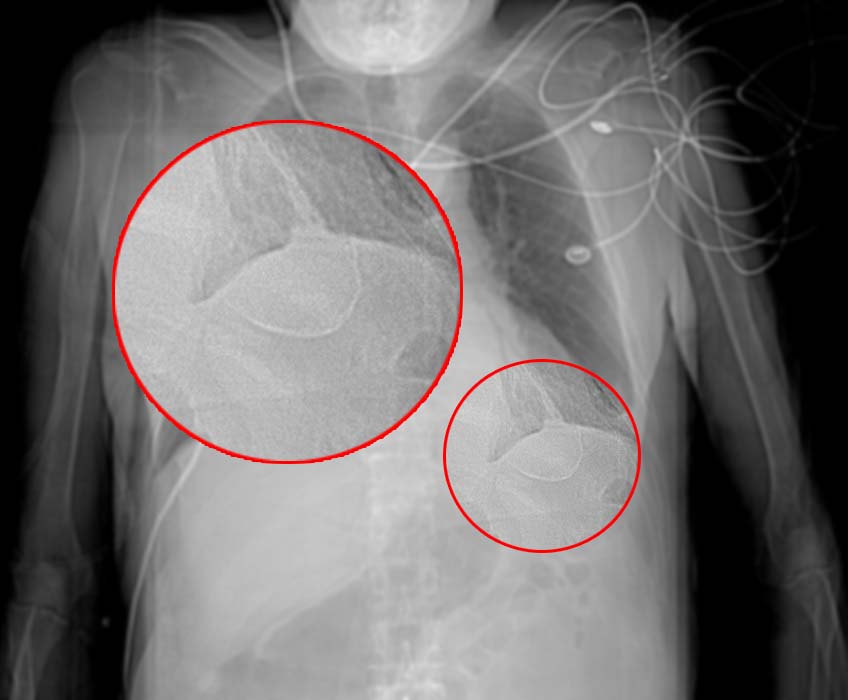 Chest X-Ray: Calcified ventricular aneurysm