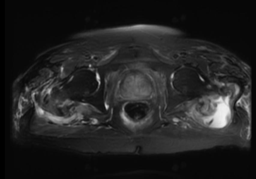 File:Greater trochanter bursitis MRI 002.jpg