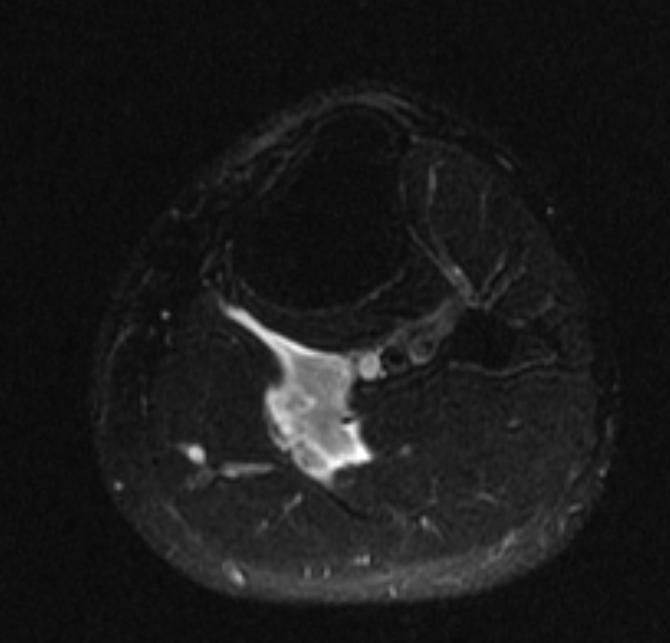 File:Plantaris rupture MRI 004.jpg