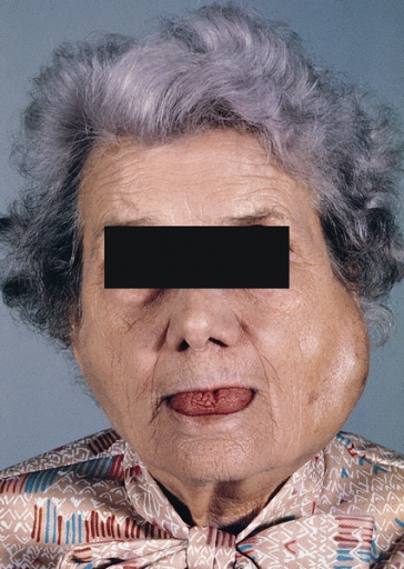 SALIVARY GLANDS: SJÖGREN'S SYNDROME Along with the symptoms of keratoconjunctivitis sicca and xerostomiathis, this woman has marked enlargement of the left parotid gland and slight enlargement of the right parotid gland, which are features of primary lesion.