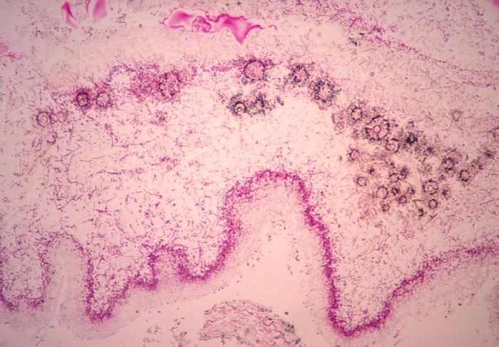 This micrograph depicts the histopathologic features of aspergillosis including the presence of conidia-laden conidiophores. From Public Health Image Library (PHIL). [2]