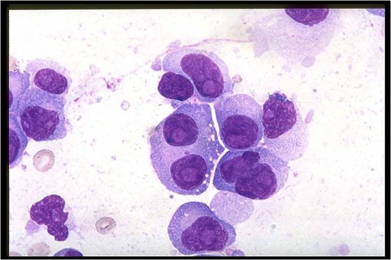 Bone marrow in multiple myeloma