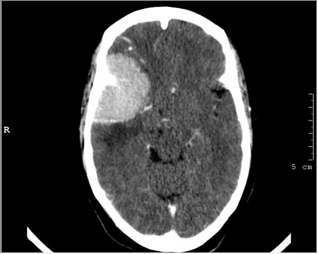 Cerebral convexity meningioma[1]