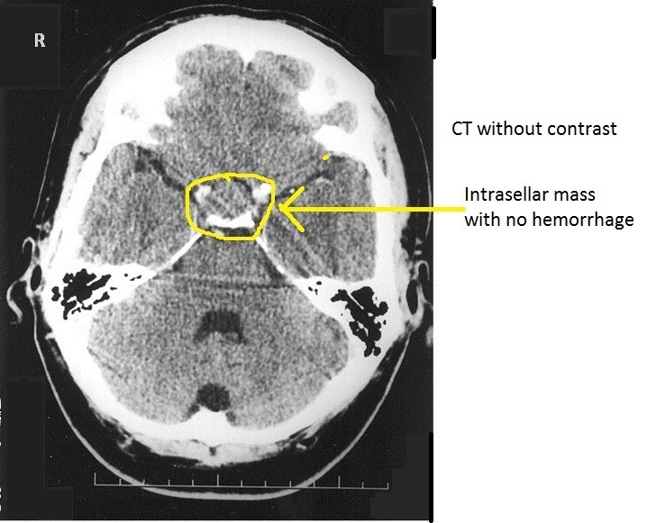 CT without contrast showing intrasellar mass.