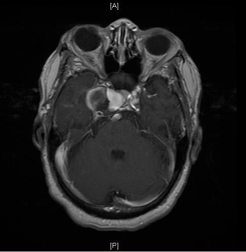 MRI: A large cavernous sinus aneurysm