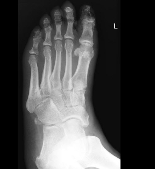 Loss of soft tissue over the great toe, with further lucencies in the surrounding soft tissue associated patchy osteoporosis in underlying phalanx in a diabetic foot patient